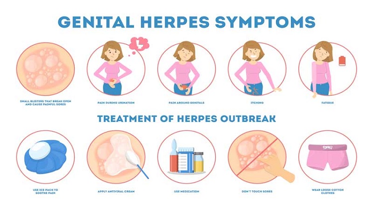 genital herpes treatment over the counter