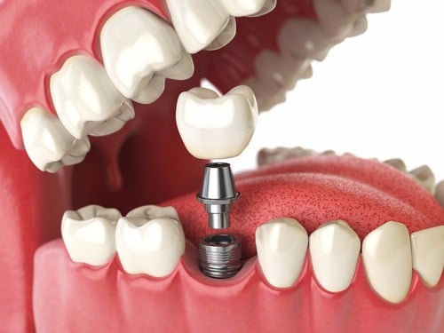 dental implants in Inglewood
