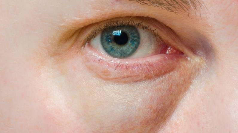 How to Get Rid of Under-Eye Dark Circles