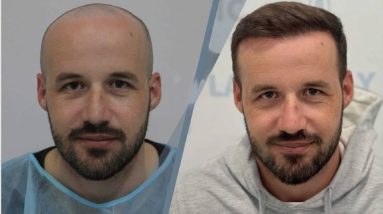 Unveiling the Transformation FUE Hair Transplant for Natural, Lasting Results